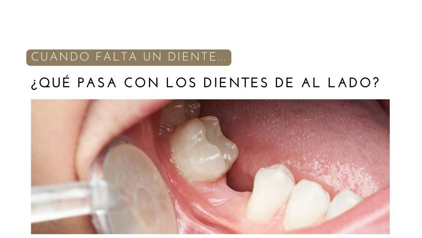 Cuando Falta un Diente, ¿Qué Pasa con las Piezas de al Lado?